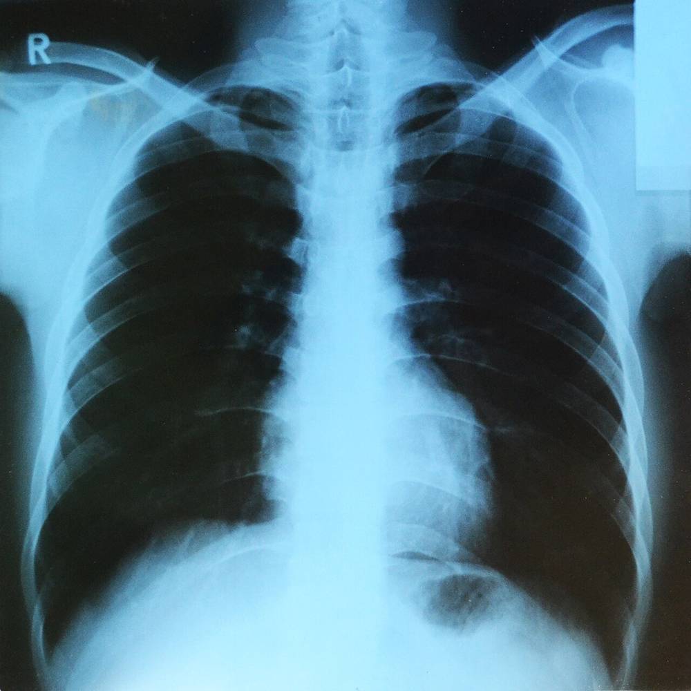 Radiografia del torace con i polmoni